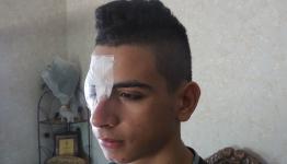 طفل فلسطيني يفقد عينه اليمنى جراء اطلاق نار