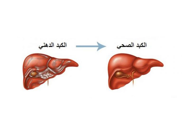5 علامات احذرها.. أعراض الكبد الدهني